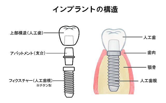 インプラント治療について